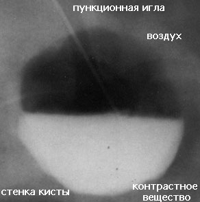 Введение пункционной иглы