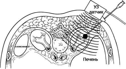 Пункция под контролем УЗИ