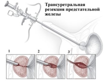 ТУР предстательной железы