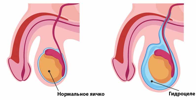Гидроцеле яичка (водянка) Гидроцеле яичка (водянка)