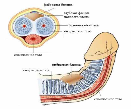 Болезнь Пейрони Болезнь Пейрони