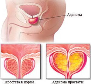Болезни простаты у мужчин