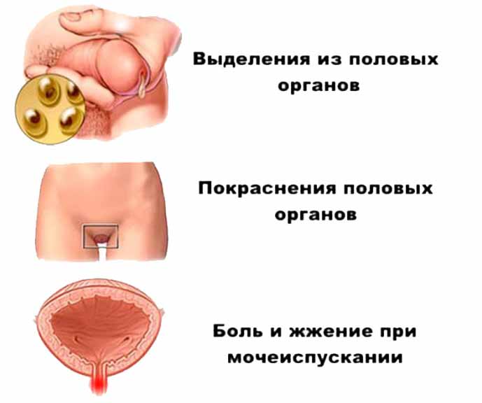 Болезни передающиеся половым путем Болезни передающиеся половым путем